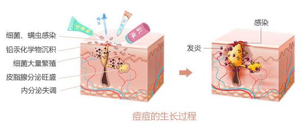 过敏性肌肤如何快速祛除痘痘