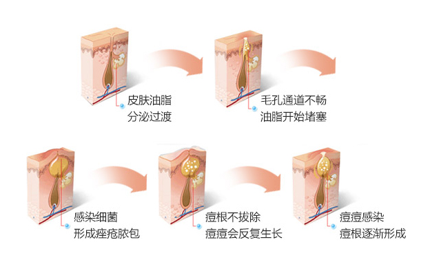 祛痘方法