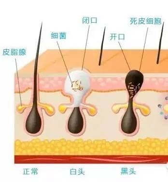 黑头粉刺