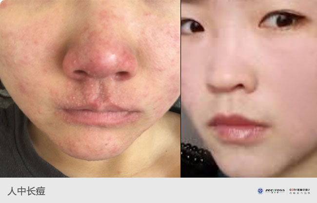 开发区人中长痘开发区人中长痘的原因开发区人中长痘怎么处理开发区