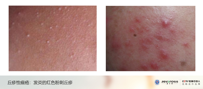 女性珠丘疹图片大全 女性尿道口长疙瘩图片