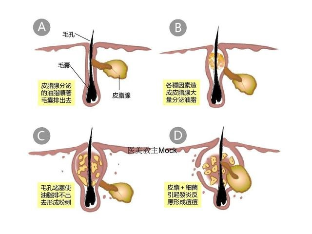 青春痘和成人痘有什么区别