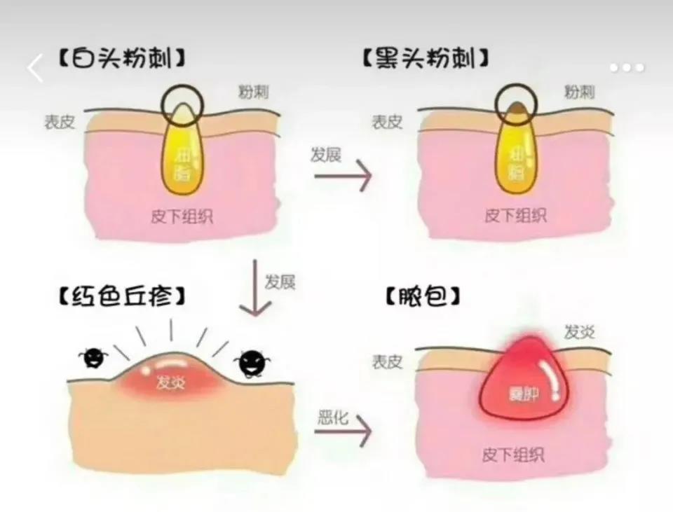 青春痘和成人痘有什么区别