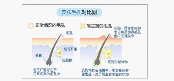 泽十字专业祛痘