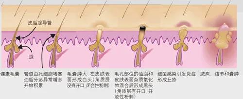 泽十字专业祛痘