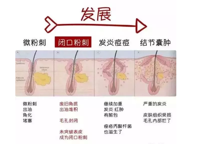 泽十字专业祛痘